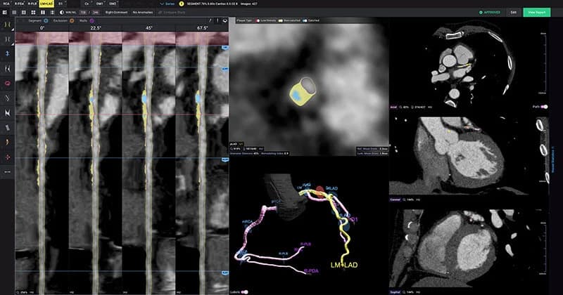 Cleerly AI plaque analysis showing a color-coded 3D view of coronary arteries