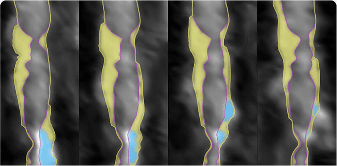 Cleerly AI plaque analysis showing color-coded plaque segmentation across coronary arteries