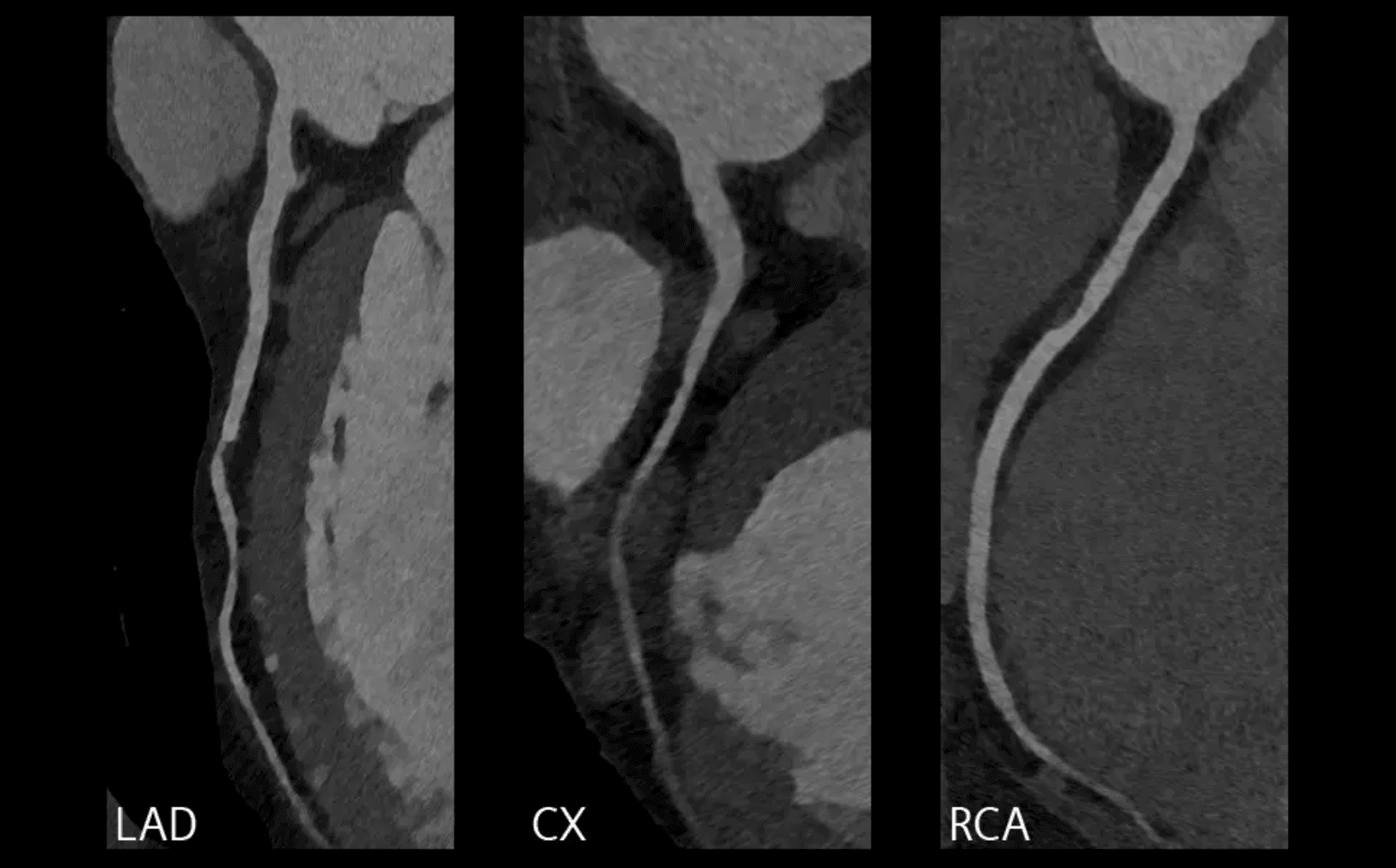 CT angiogram result showing the main coronary arteries